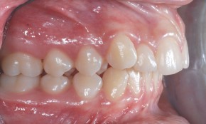 1. mandibola deviata inizio laterale dx
